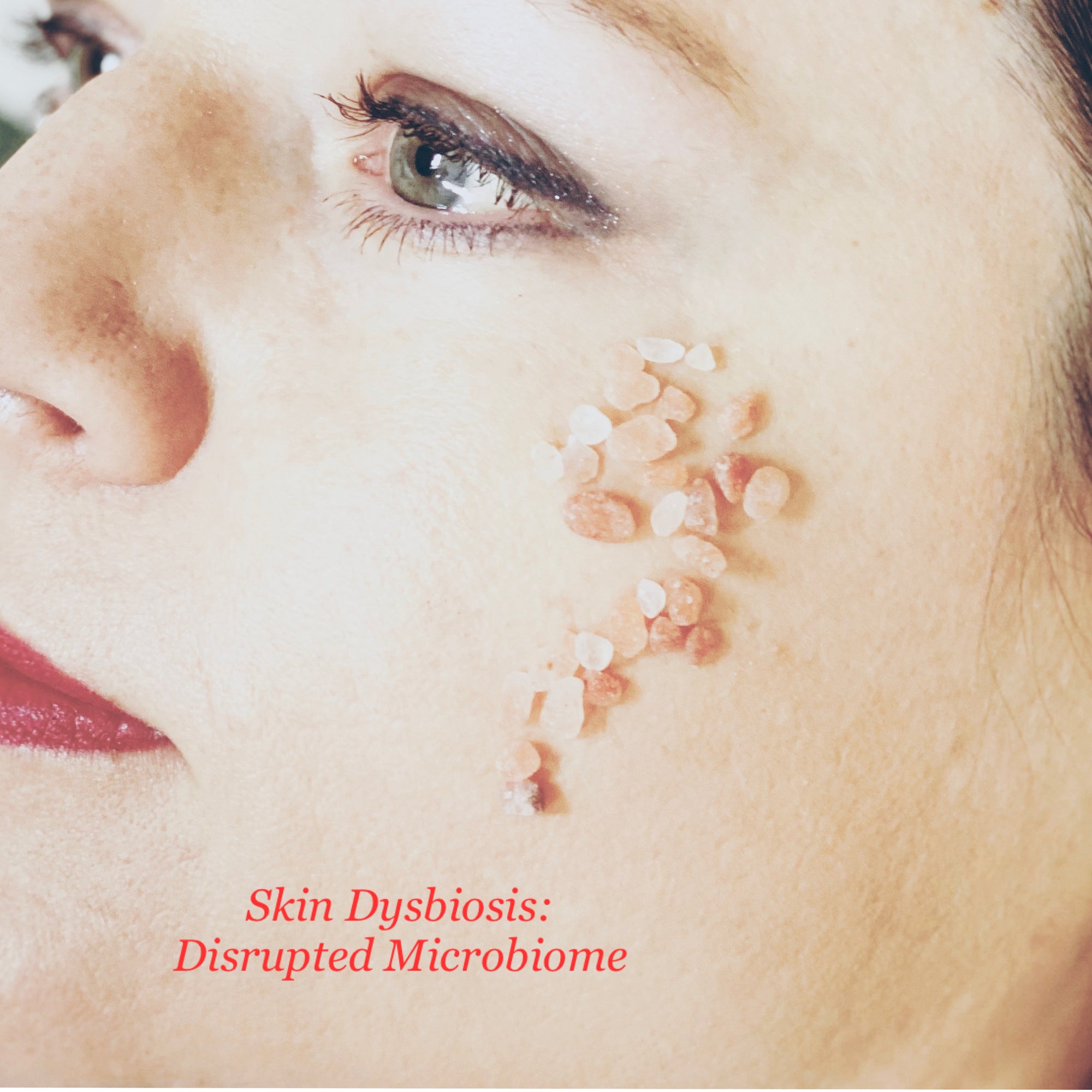 Skin Dysbiosis: Microbiota Diversity and Its Impact on Skin Health