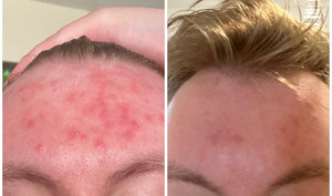 Eco-Balance Blemish Defence Serum with Phages and Niacinamide