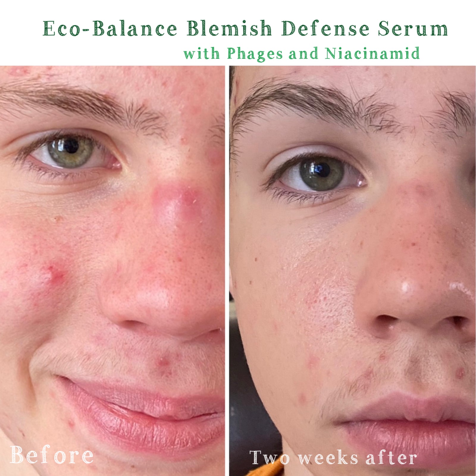 Eco-Balance Blemish Defence Serum phages niacinamide bottle